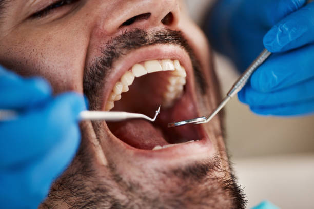 Best Knocked-Out Tooth (Avulsed Tooth) Treatment in Seven Fields, PA